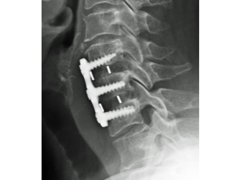 Two-level cervical fusion with 6mm Integra interbody spacer